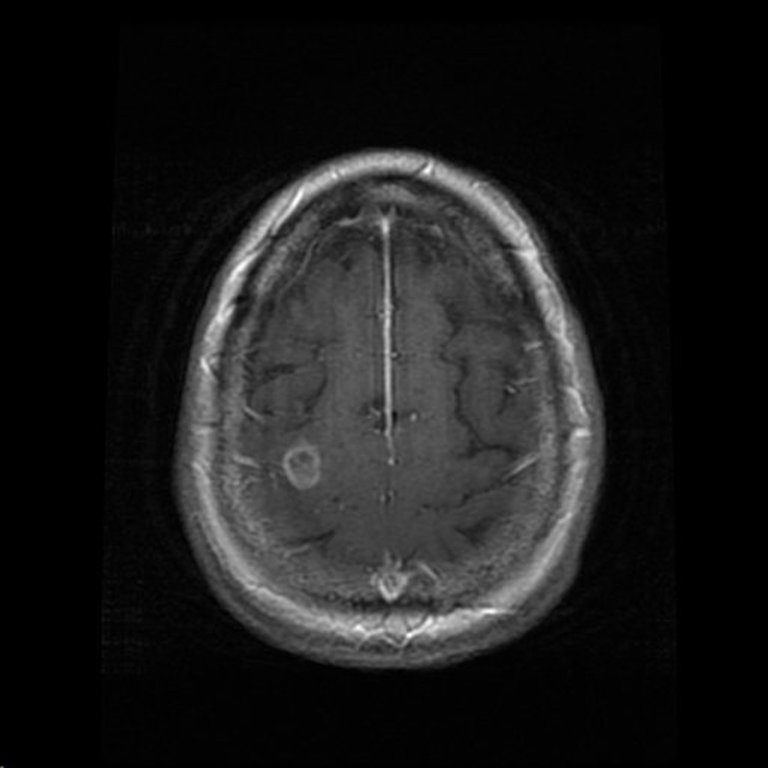 brain CT scan