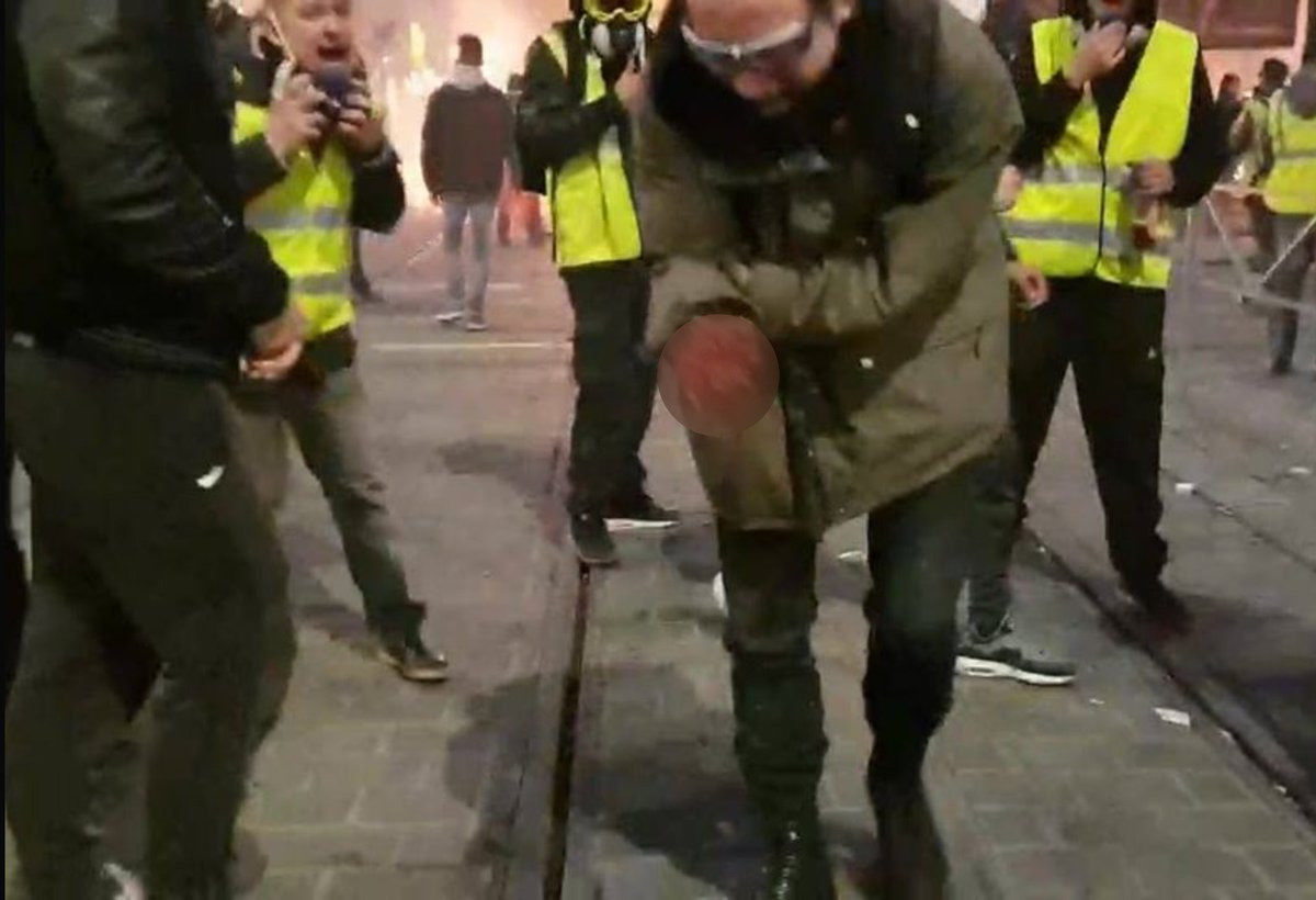 yellow vest man hand blown off