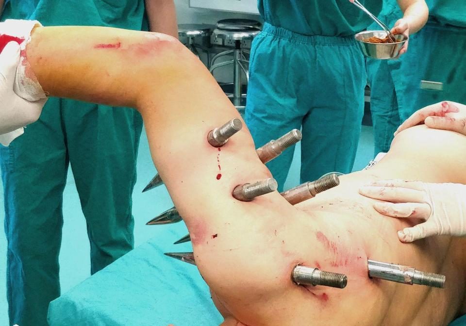 Click to enlarge One of the skewers narrowly missed an artery