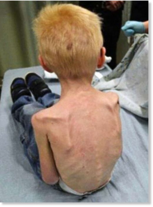 Click to enlarge malnourished child