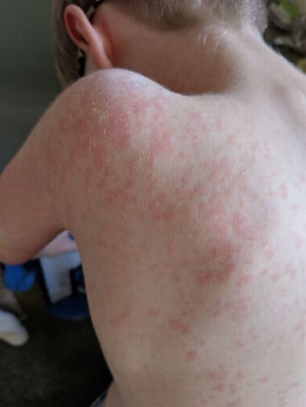 Click to enlarge measles