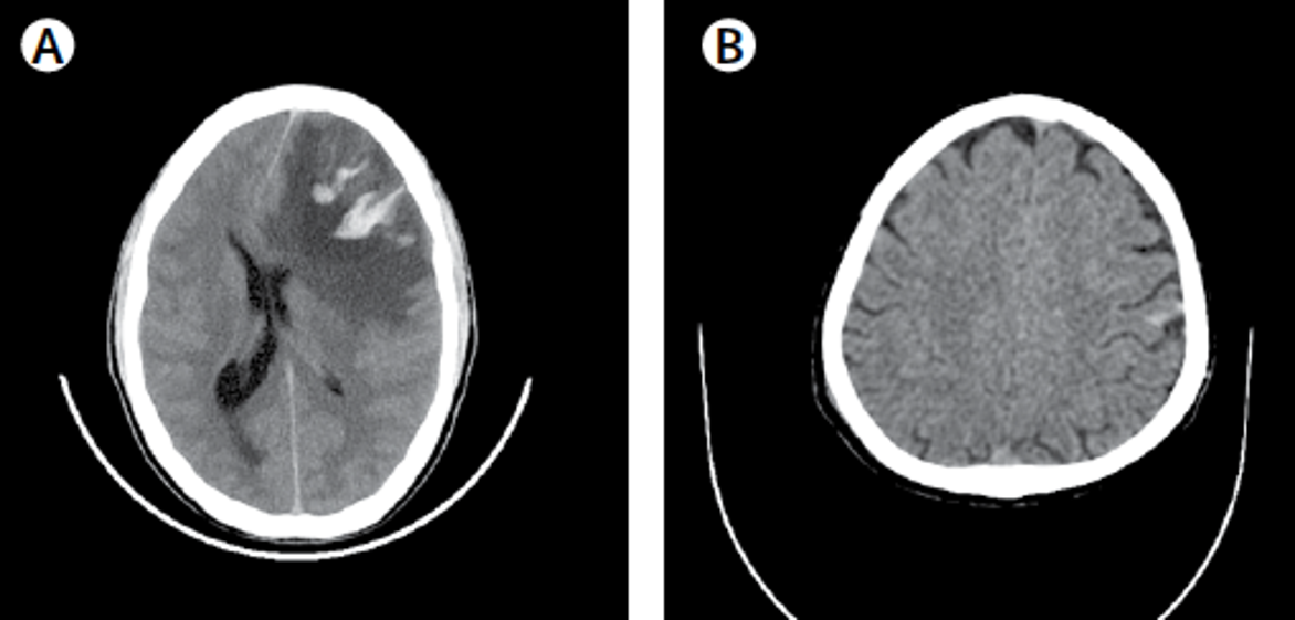 Brain scan AI identification head trauma