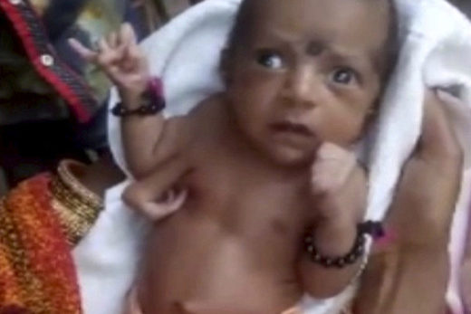 Baby girl in India born with three hands