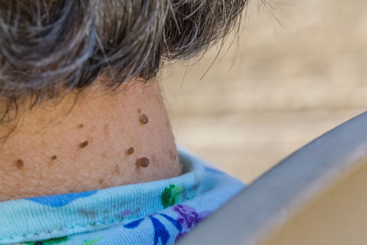 skin tags