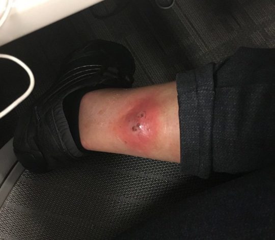 Click to enlarge spider bite