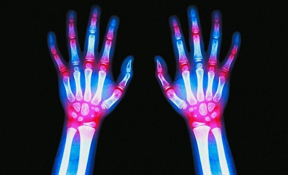 arthritis
