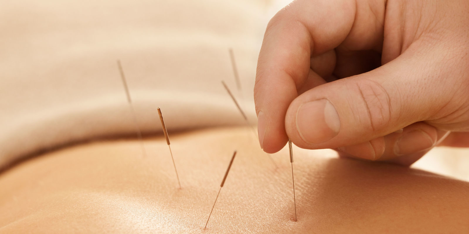 acupuncture