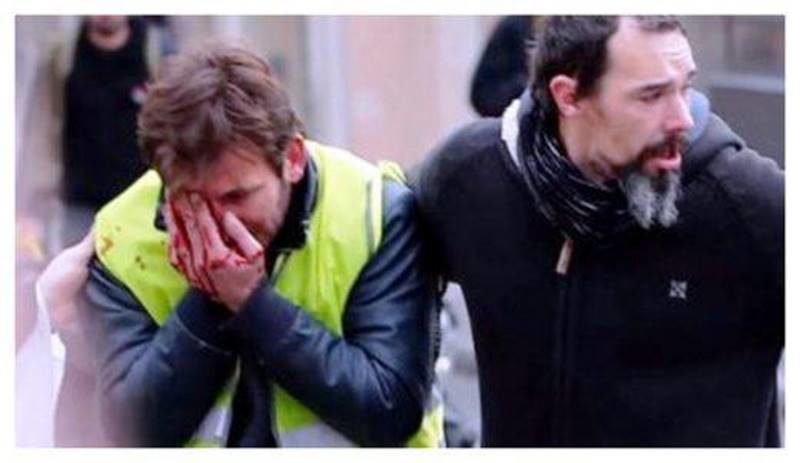 Click to enlarge yellow vest protest injury