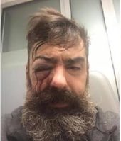 Ranjeni Jerome Rodrigues yellow vest eye injury