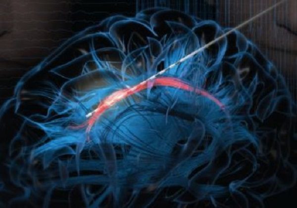 electrode in brain