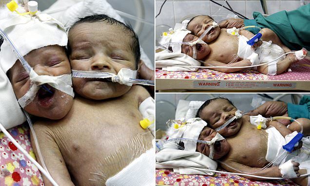 The babies have spent the first days of life in an incubator at Al-Thawra hospital, Yemen