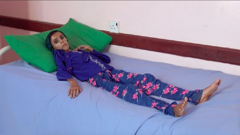 Yemen starving girl