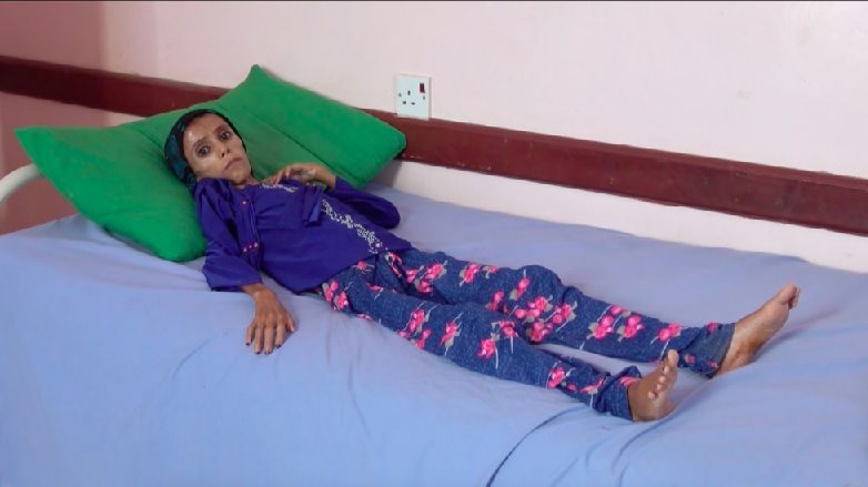 Click to enlarge Yemen starving girl