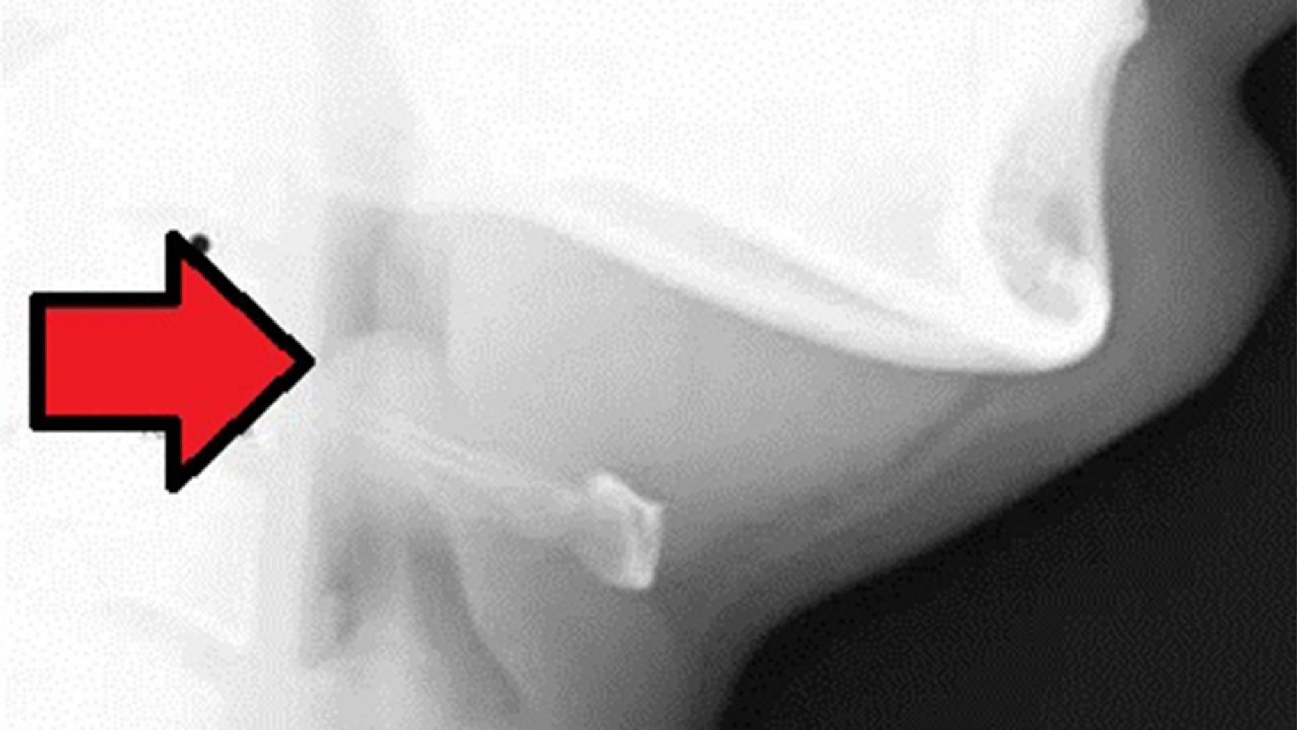 Click to enlarge Acute epiglottitis