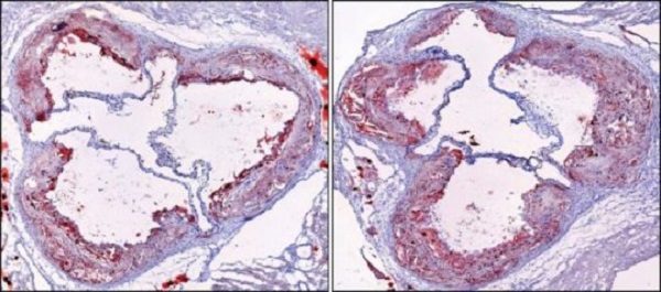 Click to enlarge arterial plaque affected by sleep