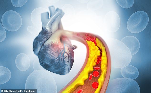 Click to enlarge atherosclerosis