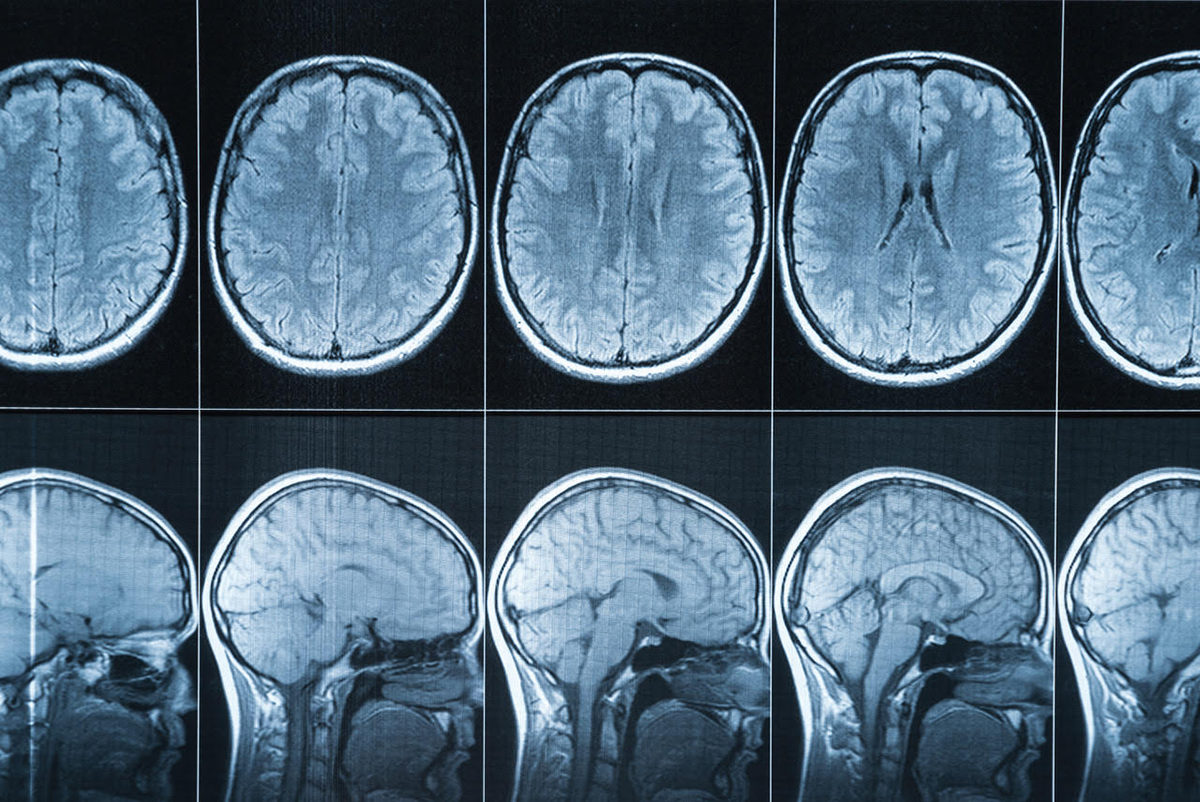 brain scans