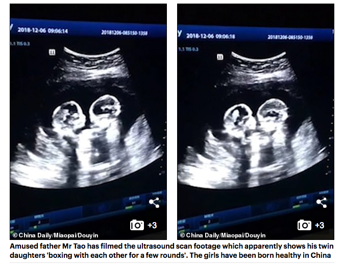 ultrasound twins boxing