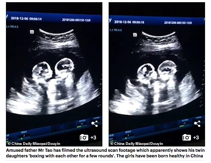 Click to enlarge ultrasound twins boxing