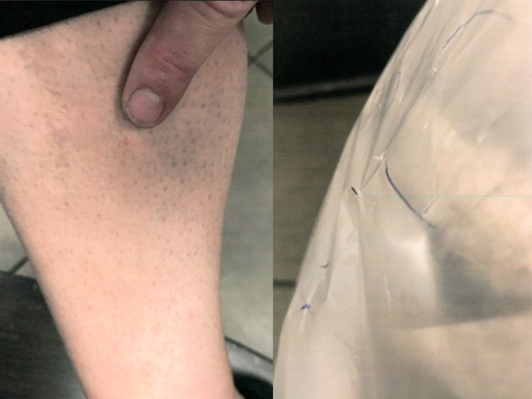Click to enlarge needle-prick injury
