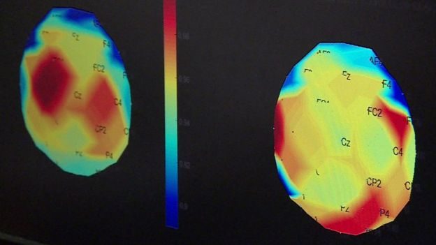 parkinson's brain scan