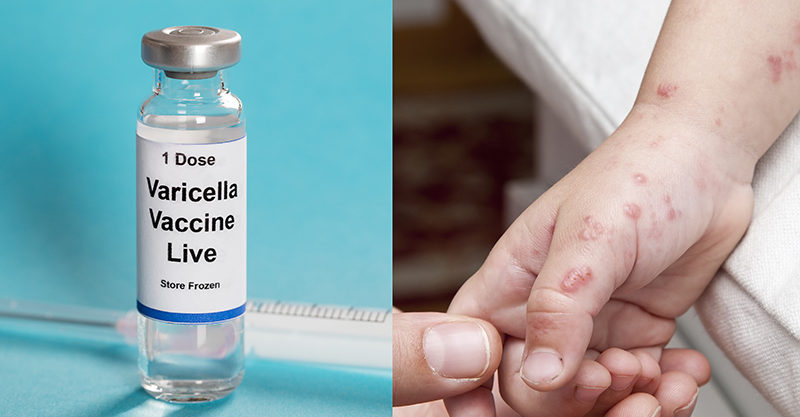 shingles chickenpox vaccine