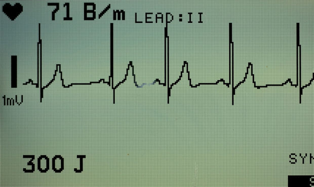 ekg machine