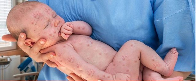 baby with measles