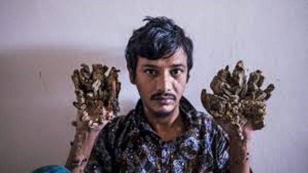 'Tree Man'