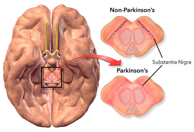 parkinsons substantia nigra