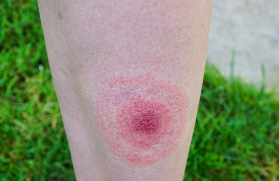 Click to enlarge bullseye rash Lyme