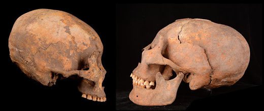 Click to enlarge cranial deformation