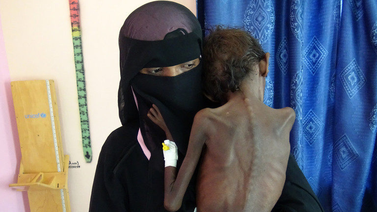 malnourished child