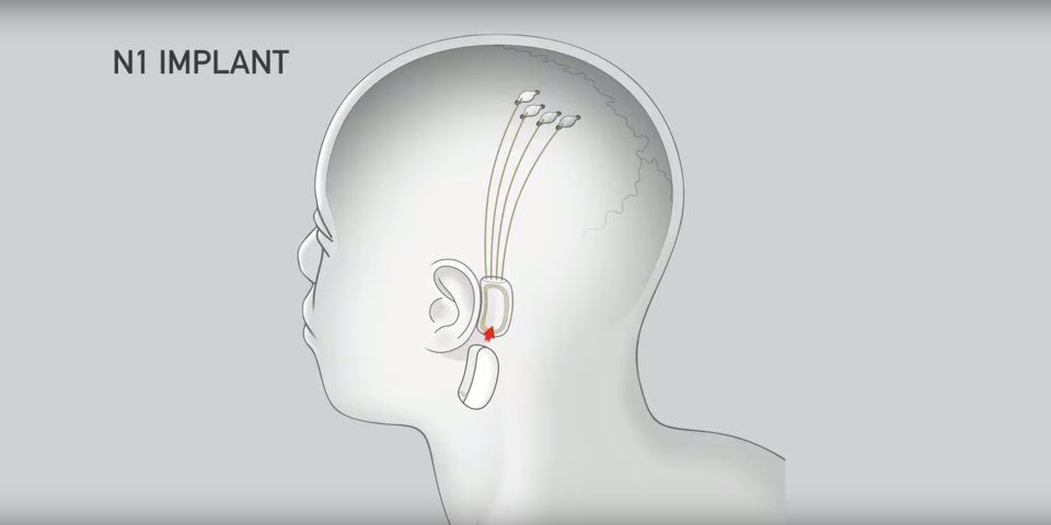 Neuralink