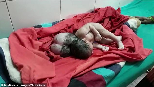 Click to enlarge Three-headed baby in India
