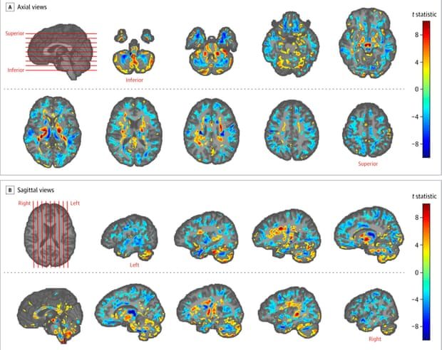 Brain scans