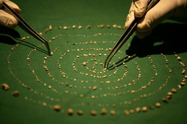Indian boy with 526 teeth