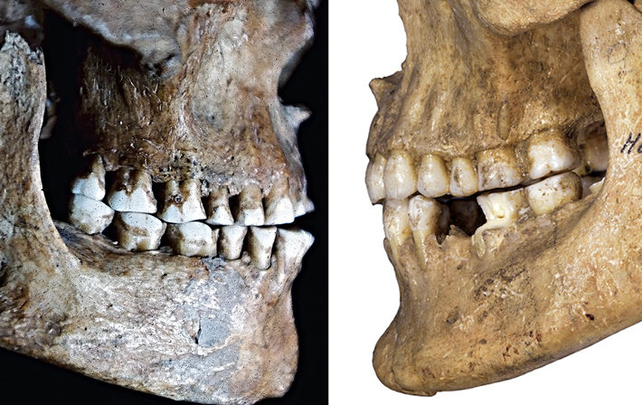 Click to enlarge skull overbite