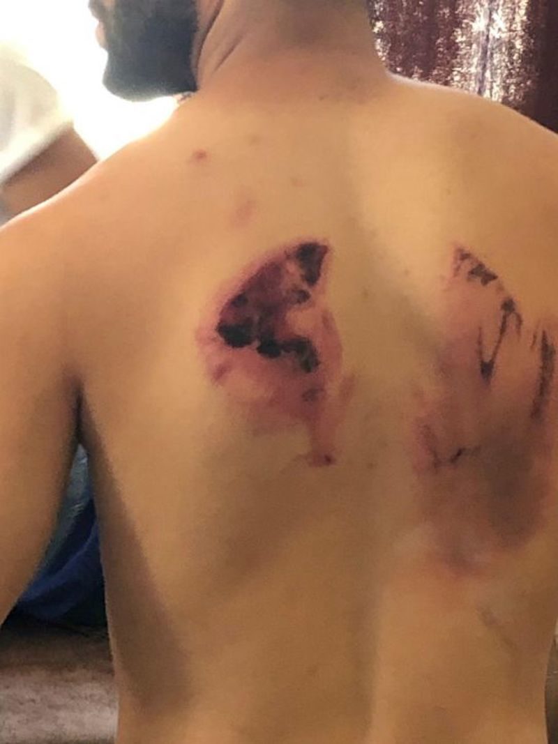 Click to enlarge Fadi Obeid’s back is still covered with bandages, as is his arm.