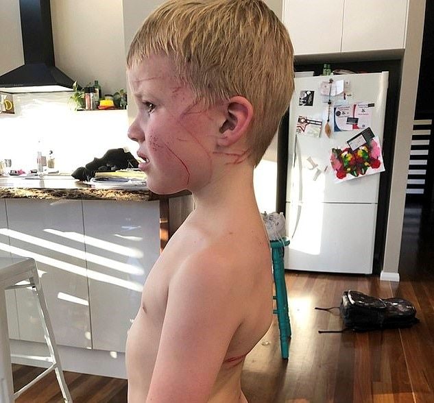 Lewis was playing with his older brother when the kangaroo attacked.