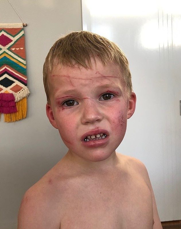 Lewis suffered puncture wounds and scratches to his head and torso.