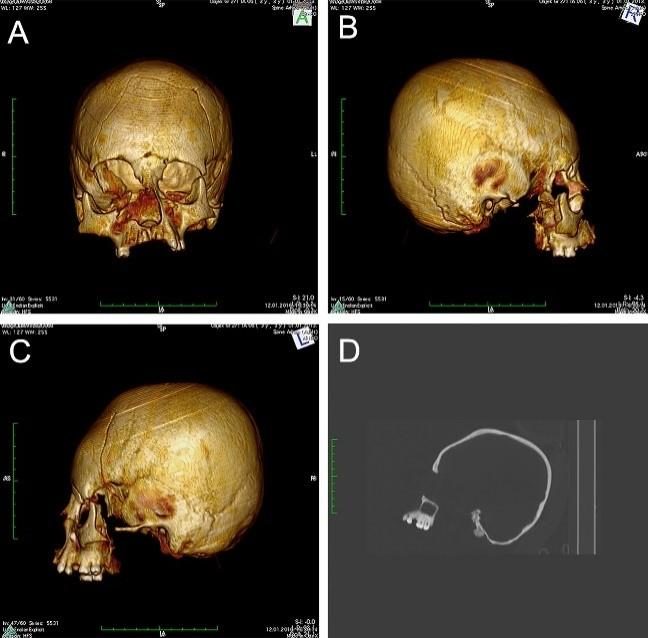 Click to enlarge cranial deformation