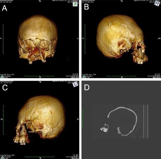 cranial deformation