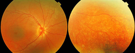 Click to enlarge retinado redo