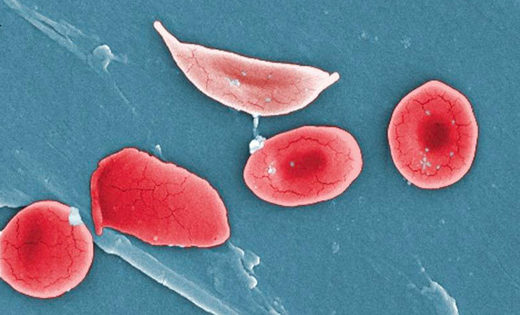 Click to enlarge CRISPR sickle-cell