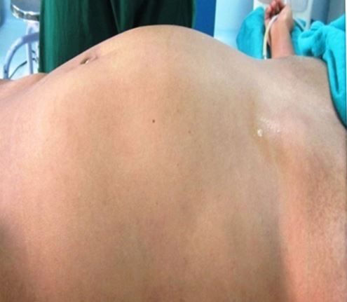 Click to enlarge stomach lump