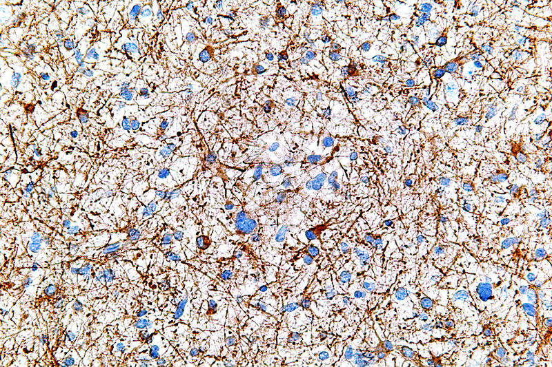 Click to enlarge brain cancer cells