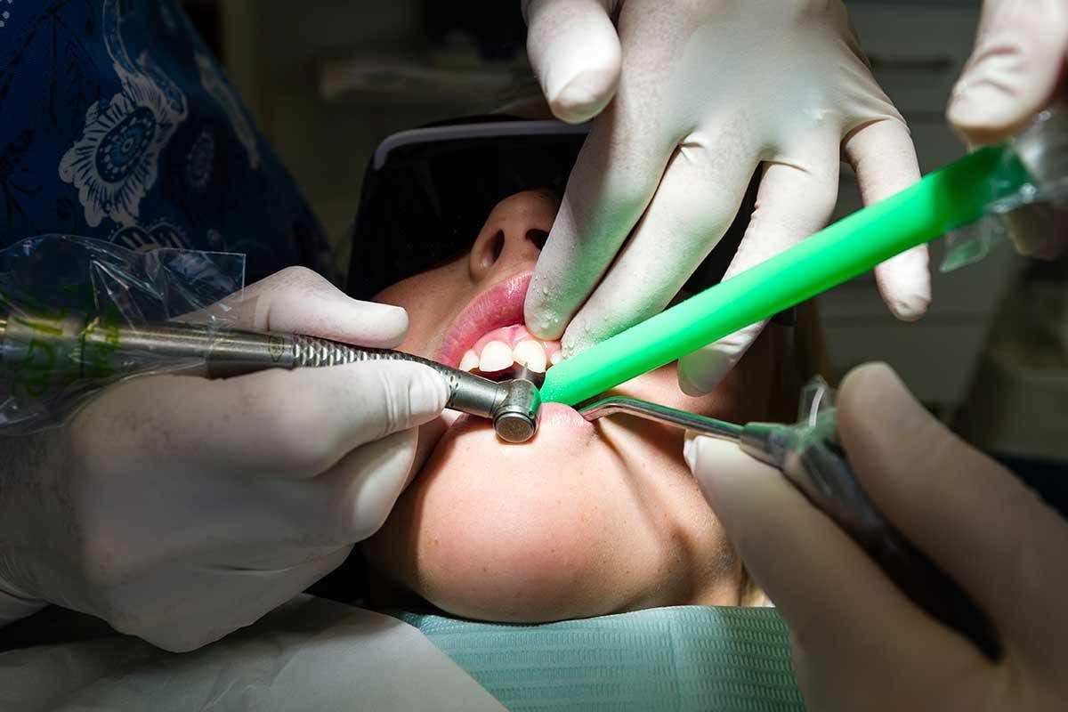 tooth repairing gel dentist
