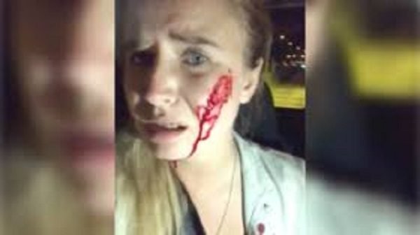 Bloodied cheek
