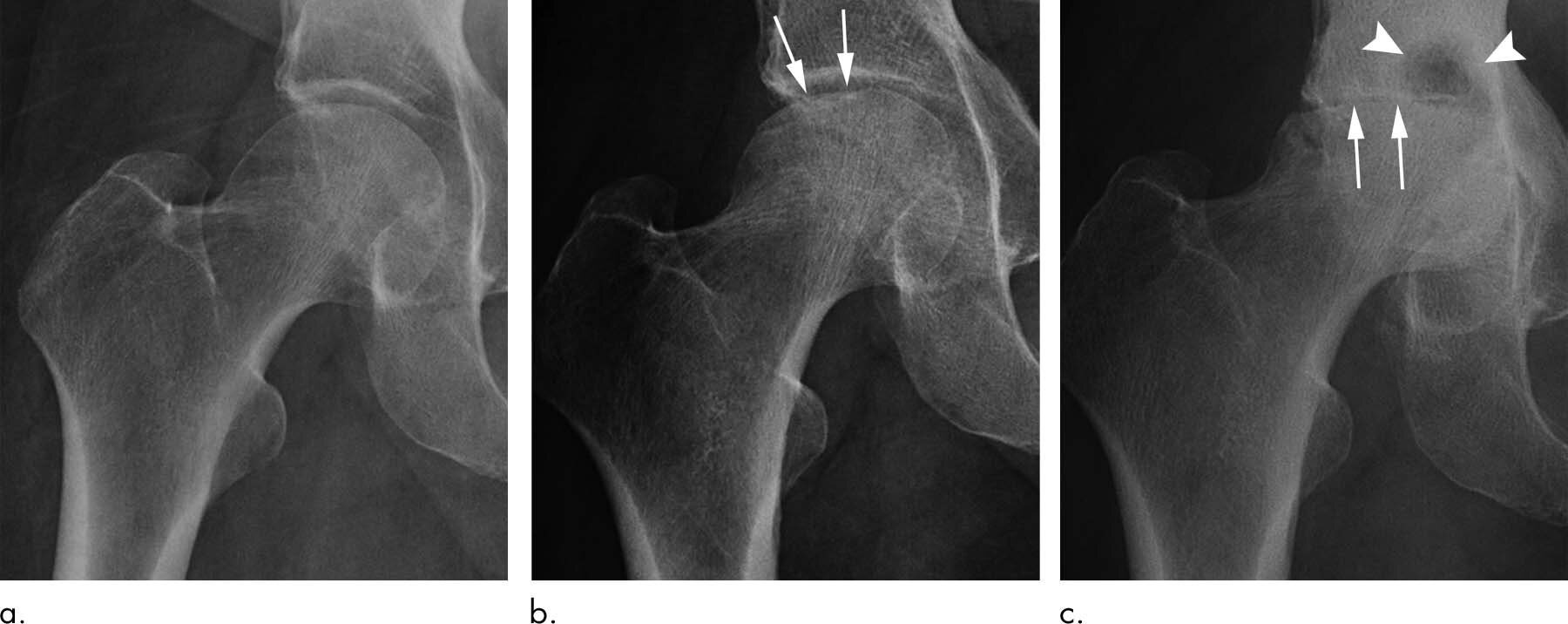 hip steroid injection